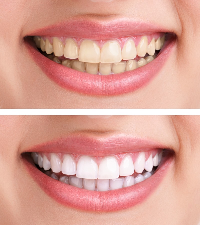 Scarsdale Teeth Whitening